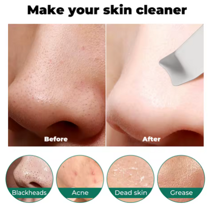 Espátula Ultrasónica Skyn Care